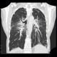 Sarcoidosis, pulmonary sarcoidosis, stage IV: CT - Computed tomography